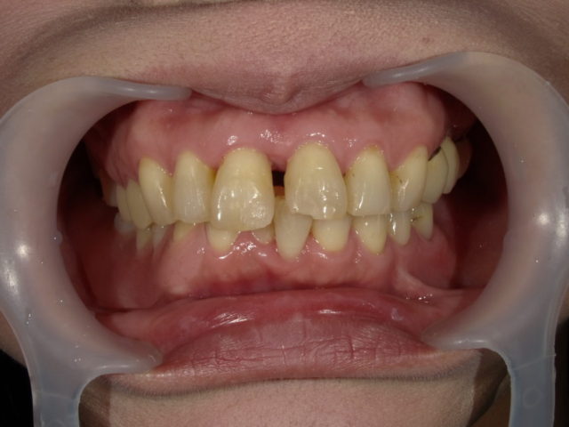 セラミック セラミック歯の特徴と価格・歯科料金相場まとめ～前歯・奥歯の値段は？