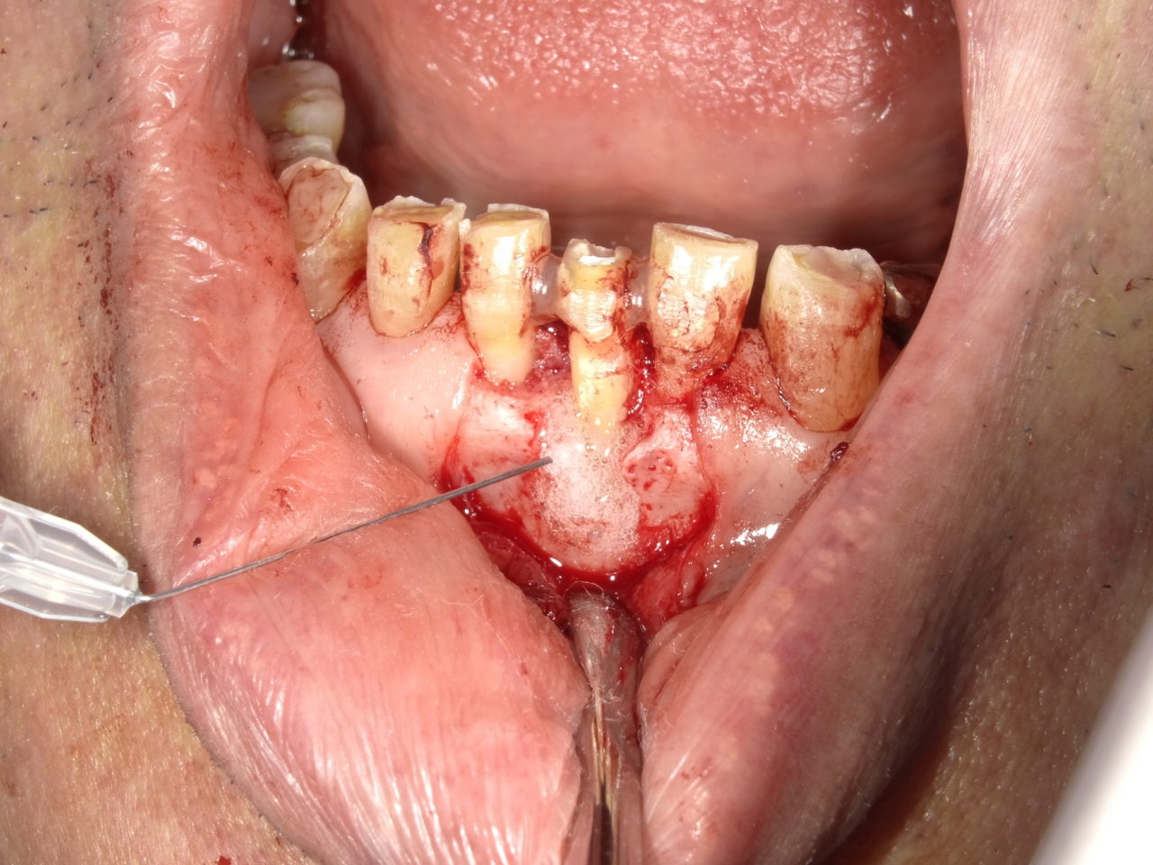 正しい歯周病の治療をしましょう - 兵庫県川西市の歯医者・歯科医院「つばめデンタルクリニック川西」