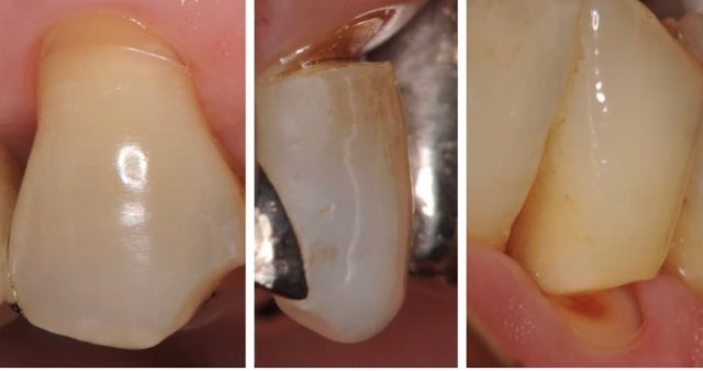 不適切な歯ブラシが歯の寿命を縮めます。NCCLについてのお話｜川西市の歯科・歯医者・インプラント・ホワイトニングなら『つばめデンタルクリニック川西』