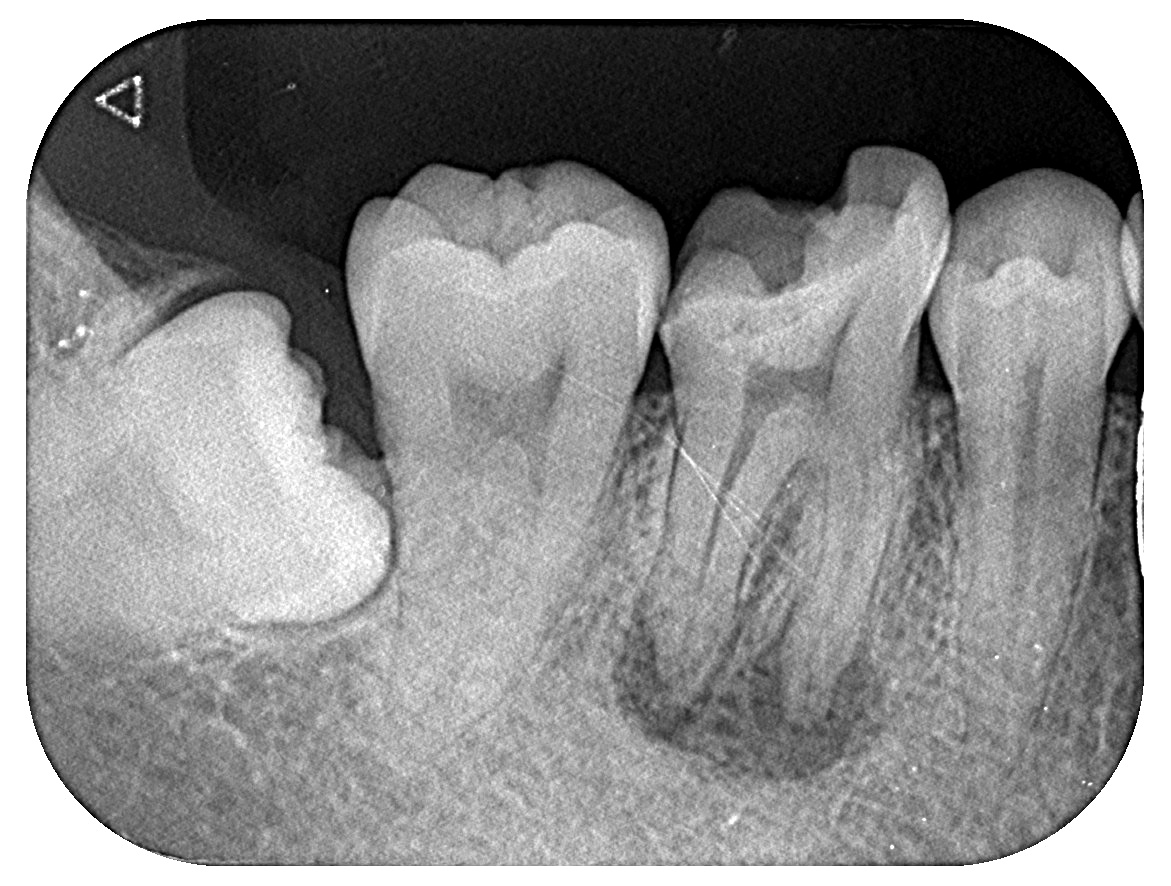 歯の膿みの痛み | 奥歯に膿がたまる – DOBR